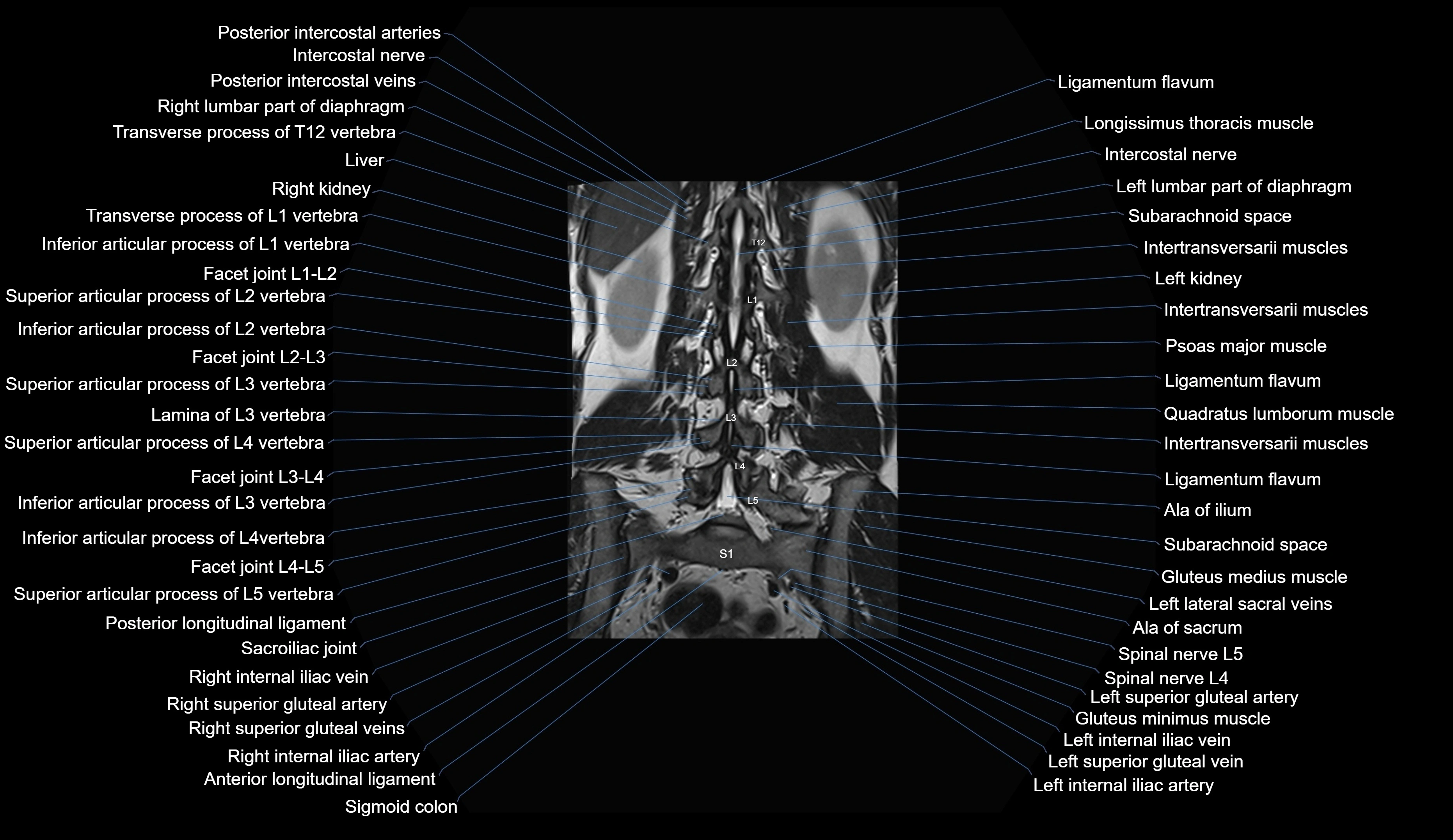 MRI lumbar spine coronal cross sectional anatomy 3T radiology  image-img-00001-00022.webp
